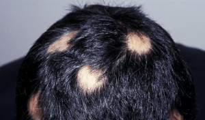 Patchwork alopecia