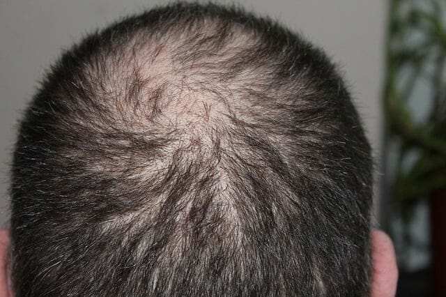 Alopecia androgena