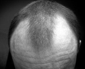 Alopecia androgena