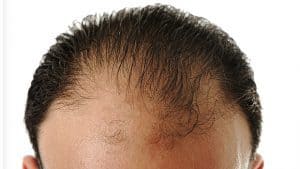alopecia