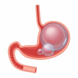  grafico raffigurante lo stomaco e l'intestino gonfio 